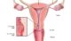 Cervical cancer treatment symptoms causes